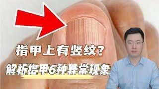 为什么指甲上有竖纹？解析关于指甲的6种常见现象！