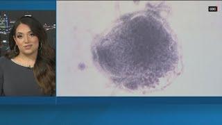 CDC issues new measles travel warning