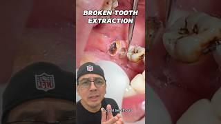 Broken Tooth & Root Tip Extraction (EASY) | In Office to Hands On Dental Training #shorts