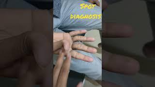 Spot diagnosis! Handgrip myotonia in myotonic dystrophy!  @Dr.KamaleshTN_MediCal_Lectures