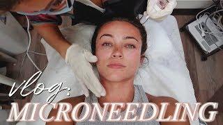 I tried MICRONEEDLING: daily vlog ft. Chef Steph