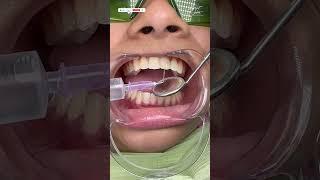 Root Canal Treatment in Kolkata | RCT Procedure Step by Step- #rootcanaltreatment #dental #dentistry