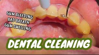 DENTAL CLEANING or ORAL PROPHYLAXIS  | With explanation | Dr. Bianca Beley