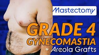 Grade 4 Gynecomastia Transformation | Double Mastectomy & Areola Grafts Explained with Dr. Dadvand