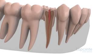 Pulpotomie - Centres dentaires Lapointe