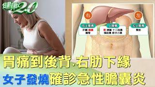 胃痛到後背.右肋下緣 女子發燒確診急性膽囊炎 健康2.0