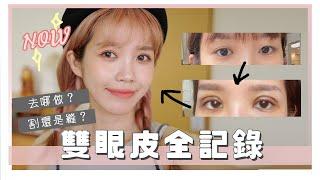 花7萬整形！雙眼皮+提眼肌手術全記錄！｜double eyelid surgery｜居妮Ginny Daily