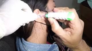 Removing Woman's Black Earwax Using Lighted Ear Curette