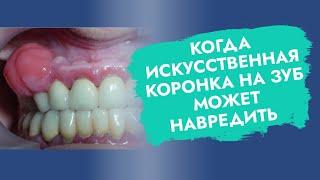 Коронки на зубы. Вред и польза. Показания и противопоказания.