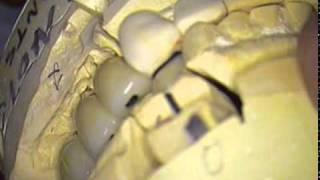 DR. GERARD CUOMO - Dental Implants Multiple 1 - Ned's Case Cosmetic Dentistry Boca Raton, Florida