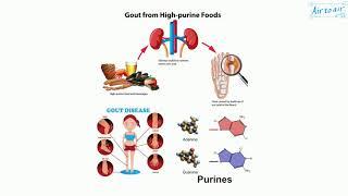 hyperuricemia