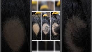 ALOPECIA ARETA #hair #aesthetic #regrowthhair #regeneration #skin #scalp #strong #viral #shorts