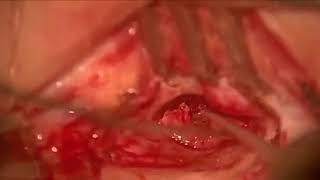 Myringoplasty - Dr. Suri Prabhu