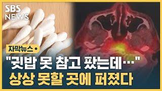 "귓밥 못 참고 팠는데…" 상상 못할 곳에 퍼졌다 (자막뉴스) / SBS