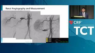 The Next Wave of Hypertension Management : Ultrasound RDN Technology and Clinical Evidence