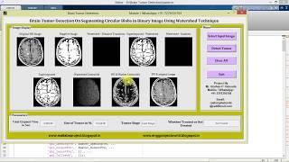 Brain Tumor Detection Using Watershed Technique Matlab PRoject Code