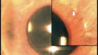 1 Slide in 5 Minutes: Neovascular Glaucoma (Malik Y.  Kahook, MD)