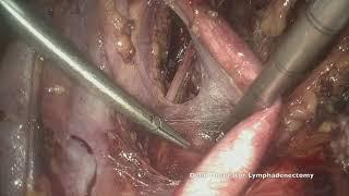 Laparoscopic sentinel lymph node mapping and lymphadenectomy by Dr. Marcello Ceccaroni, MD., Ph.D.