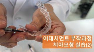 인비절라인 어태치먼트 붙이기 (치아모형) Part2. 템플릿제거