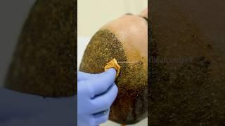 Step-by-Step Guide to Washing Your Hair After Transplant Surgery | Dadu Medical Centre