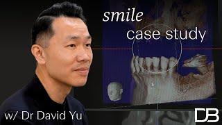 Smile Case Study - A fixed solution to dentures | Dental Boutique™