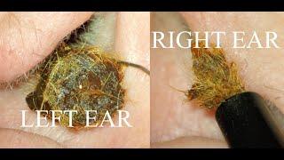 HAIRY IMPACTION : BOTH EARS : 4K/HD