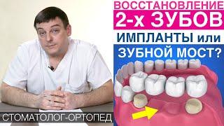 Восстановление 2-х зубов - зубной имплант или зубной мост?