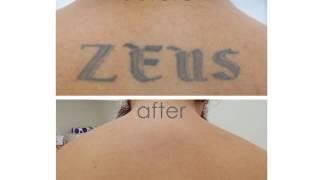 Zapatat Tattoo Removal Progression Video - 2