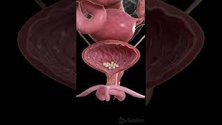 Bladder Stones in 3D | Vesical Calculi Anatomy