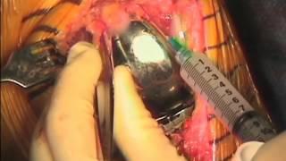 EXPAREL Technique, Total Knee Arthroplasty - Mitros