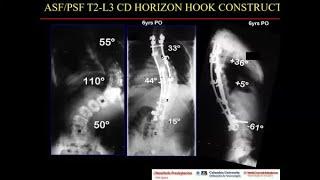 Faculty Perspective: CD Horizon Instrumentation for Spinal Deformity, 40th Anniversary w/ Dr. Lenke