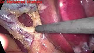 Dr. Mohamed Shehata, Laparoscopic Cholecystectomy, Tanta University, Egypt