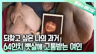 몸무게 160kg 허리 64인치, 흘러넘치는 뱃살에 고통받는 여인┃160kg (352lbs) Woman Suffers Due to Her Drooping Stomach