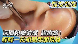 【網友熱搜】深層粉瘤清潔 超療癒! 輕輕ㄧ拉頑固黑頭現身Super deep blackhead removal｜TVBS新聞