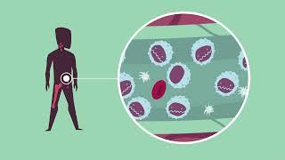 CLL - Qu’est-ce que la leucémie lymphoïde chronique ?