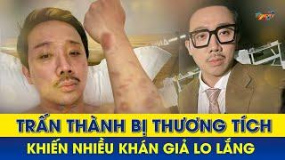 Trấn Thành bị thương tích đầy mình khiến cộng đồng mạng lo lắng