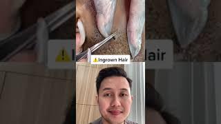 @dr.richardyl #ingrownhair #drrichardyl