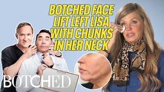 Lisa's Pelican Neck BOTCHED By Surgeon During Facelift Procedure (Before & After) | Botched | E!