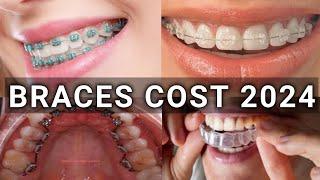 Braces Type & Treatment Cost 2024 | Metal vs Ceramic vs Lingual vs Invisalign Braces | Latest