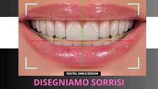 Un esempio di applicazione perfetta di faccette dentali - Studio Dentistico Cannizzo