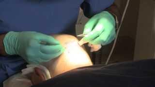 FUE Hair Transplant at The Wimpole Clinic, London