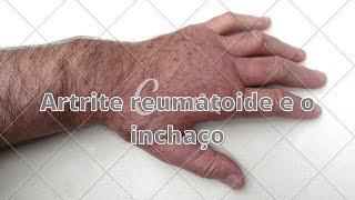 Artrite reumatoide e o inchaço