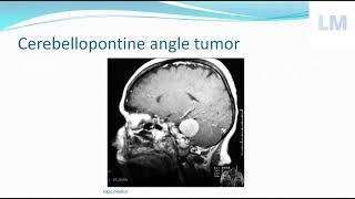 CP angle tumor|Acoustic neuroma|vestibular schwannoma|Cerebellopontine angle tumor| @ logic medico|