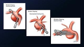 Microsurgical Clip Reconstruction of a De Novo Dolichoectatic Middle Cerebral Artery Aneurysm