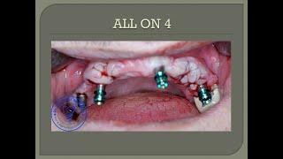 Full Mouth Rehabilitation by Implant Supported Fixed Prosthesis by #dr.anwar.alabdullah