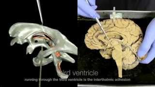 Ventricular System of the Brain