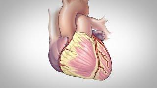 Coronary Artery Bypass Surgery