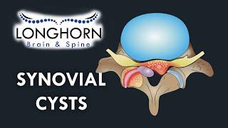 Longhorn Brain and Spine - Synovial Cysts