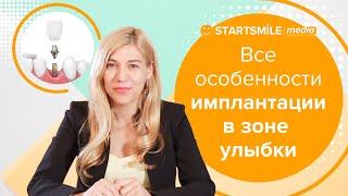 Имплантация передних зубов | Методы и особенности процедуры