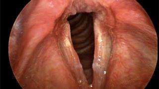 Laryngitis - a patient education video